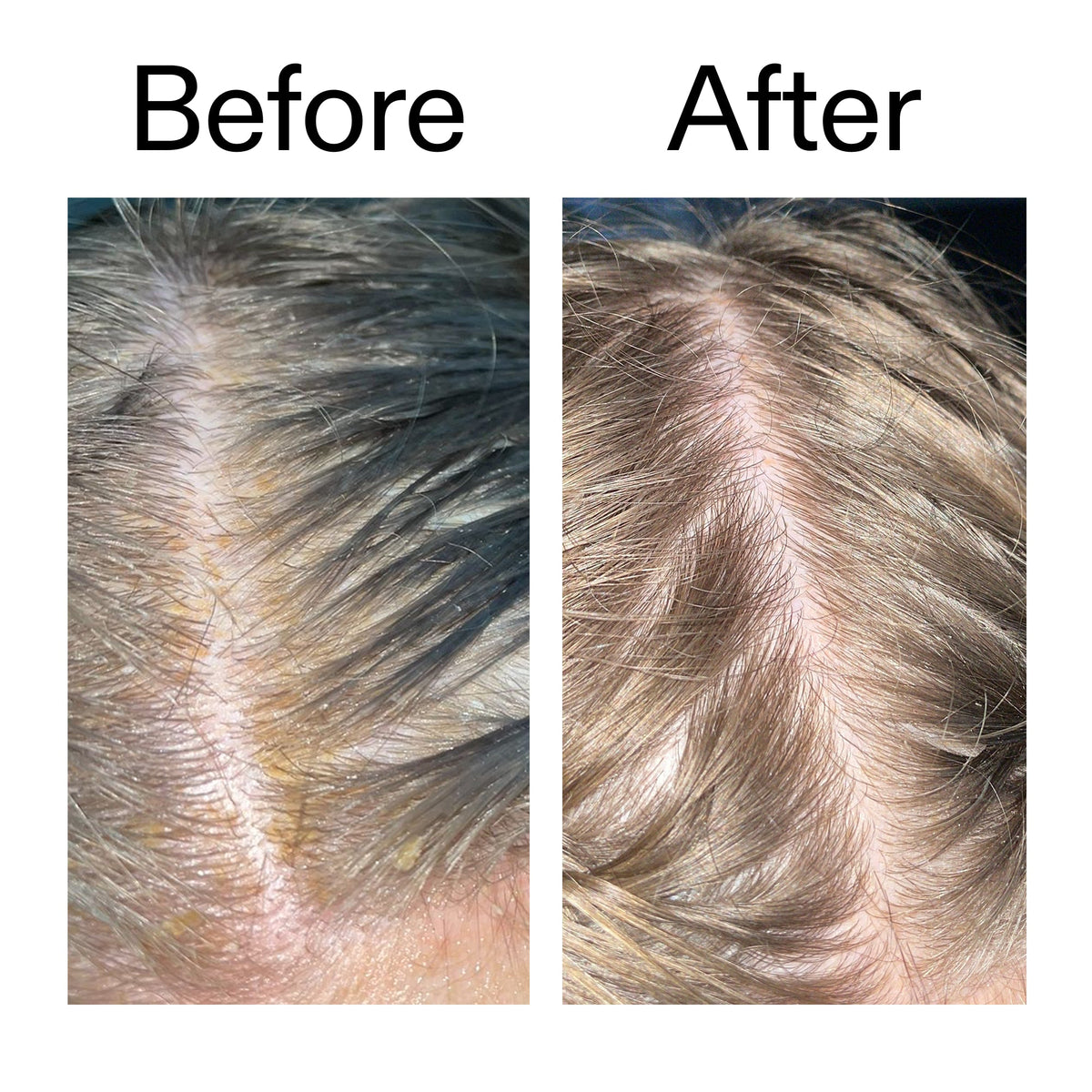 salicylic-acid-exfoliating-scalp-treatment-h5 Salicylic_Acid_Exfoliating_Scalp_Treatment_Before_After_2000x2000_e572a30f-057c-4a48-823b-1c09dc97f8d0.jpg