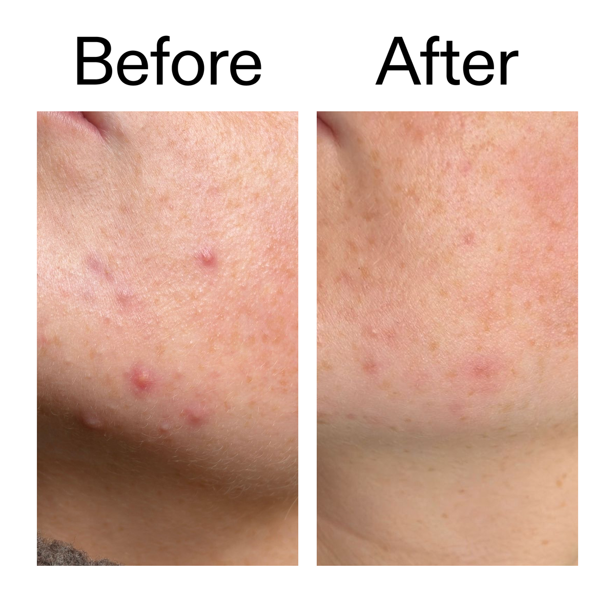 10-azelaic-acid-serum-for-redness-relief-m0 B_A_1_PPAGE.png