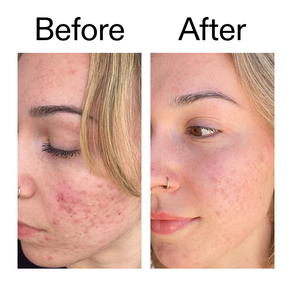 10-azelaic-acid-serum-for-redness-relief-m0 B_A_2_PPAGE.png