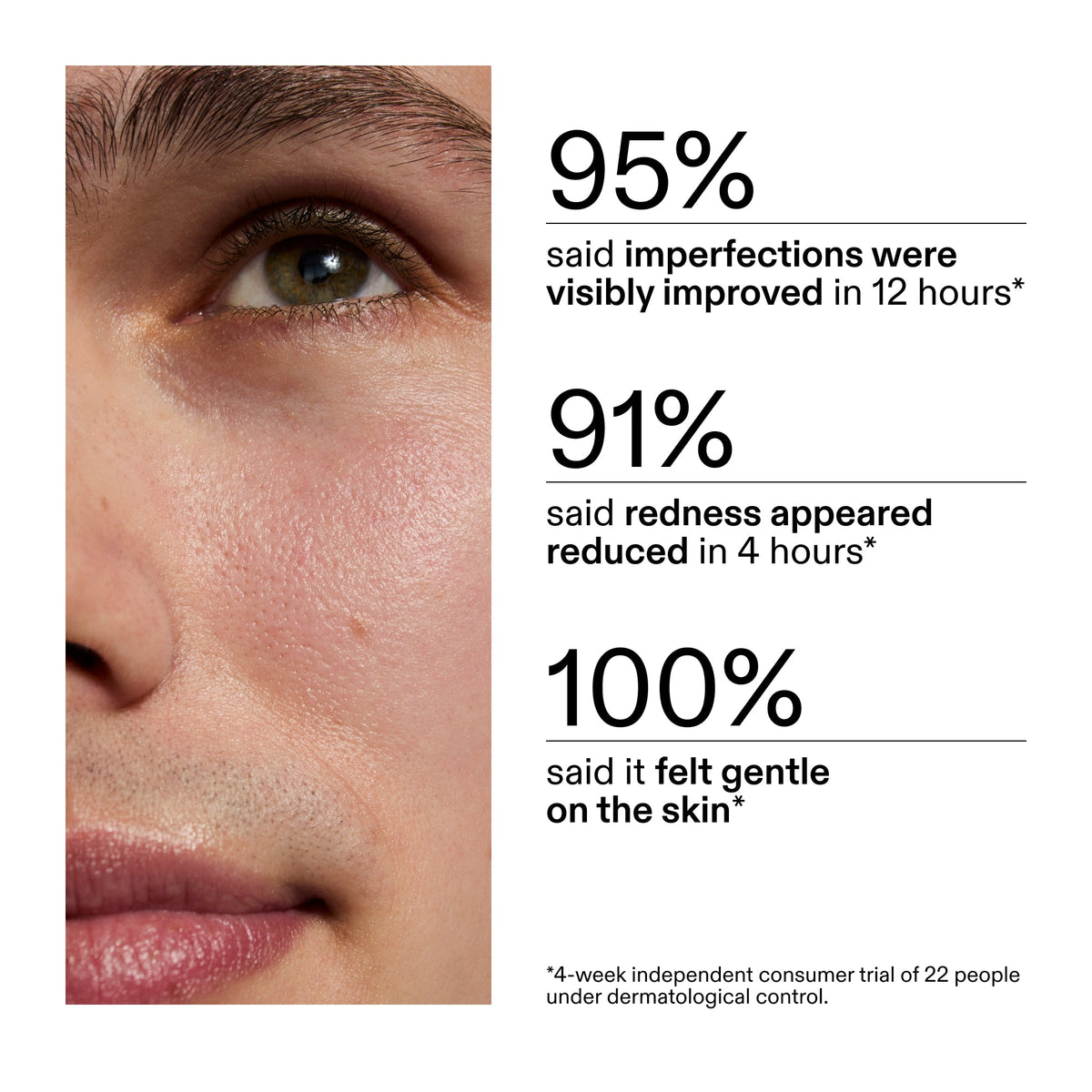 succinic-acid-acne-treatment-t4 CA_Succinic_Acid_Treatment_key_Claims_2000x2000_db91b0f1-7f29-4bfe-bb16-63a47f500960.jpg