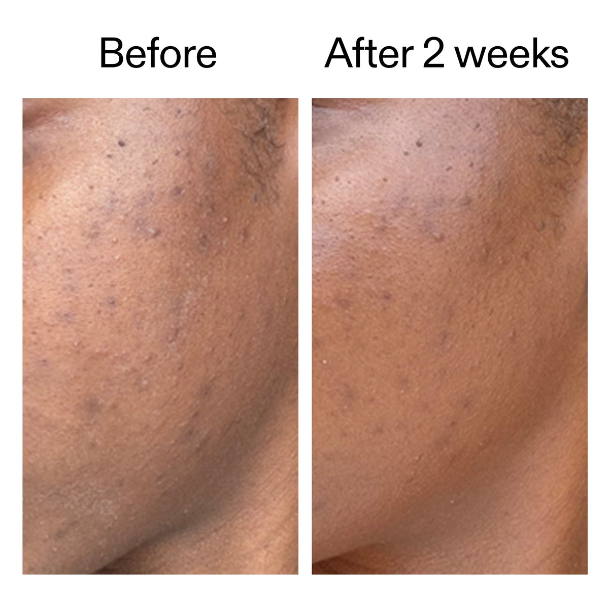 360-acne-clearing-duo-c8 DIOICB_A2000x2000.jpg