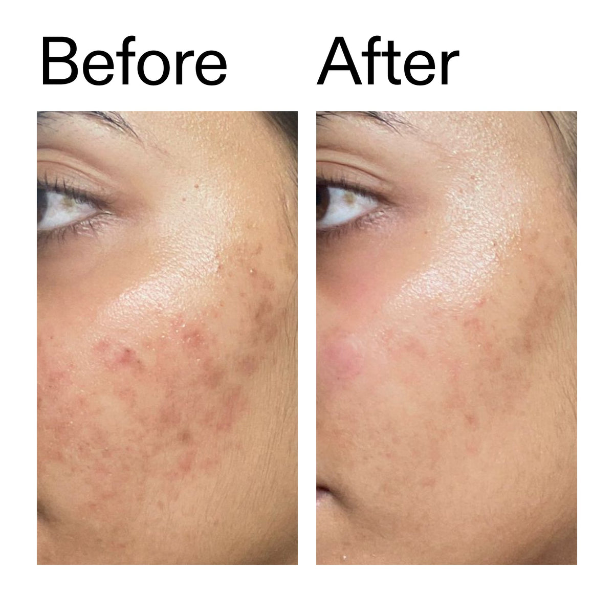 ectoin-hydro-barrier-serum-b7 Ectoin_Hydro-barrier_Serum__Before_After_2000x2000_34261920-d004-48d0-9c7b-8e1c15971bfd.jpg