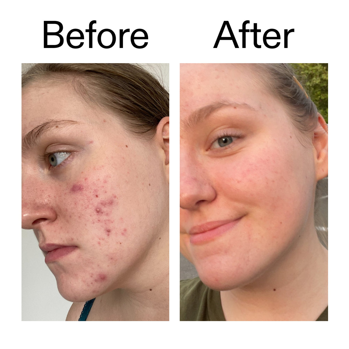 glycolic-acid-toner-n7 Glycolic_Acid_Toner_Before_After_2000x2000_49f0b9f7-e71b-4b2e-a8f8-2ea4b73247bb.jpg