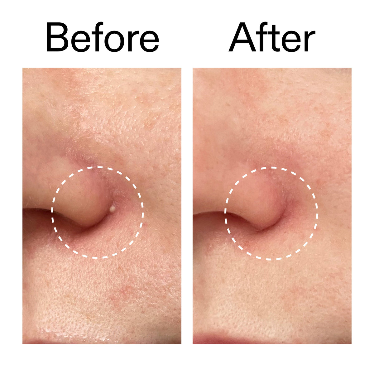 hydrocolloid-invisible-pimple-patches-pack-of-22-g2 Hydrocolloid_Invisible_Pimple_Patches_Before_After_2000x2000_b02aa37b-c78a-4682-91de-9135af5bb7df.jpg