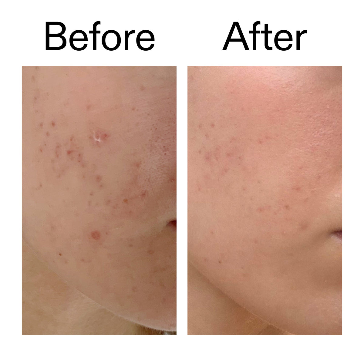 mandelic-acid-treatment-h0 Mandelic_Acid_Treatment_Before_After_2000x2000_4885ac6e-c5d7-4279-a72a-1417af7dce35.jpg