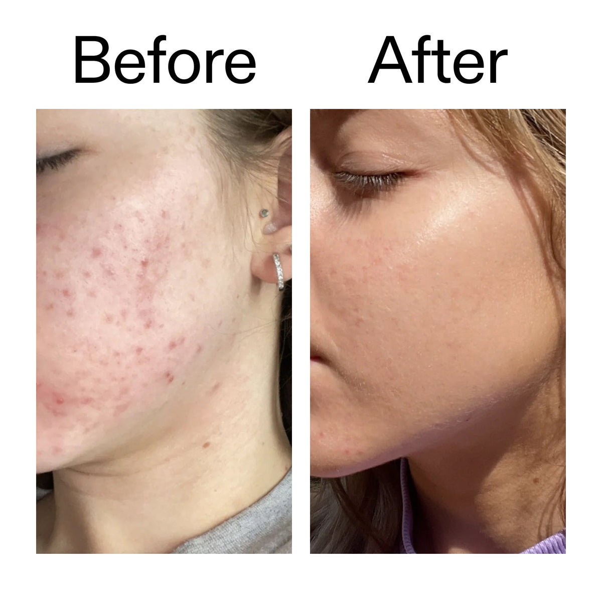 10-niacinamide-serum-duo-q3 Niacinamide_Serum_Before_After_2000x2000_bde32455-9e7d-448e-b053-bef41504f0a9.jpg