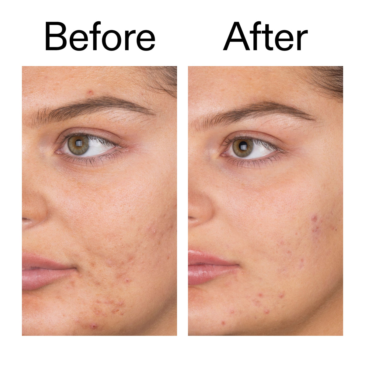 salicylic-acid-cleanser-duo-x5 Salicylic_Acid_Cleanser_-_150ml_Before_After_2000x2000_e7230494-853f-4b07-82b1-27669104c995.jpg