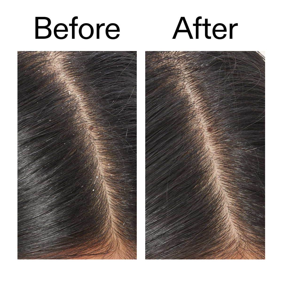 salicylic-acid-exfoliating-scalp-treatment-h5 Salicylic_Acid_Exfoliating_Scalp_Treatment_Before_After_V2_2000x2000_02bd61ad-42bf-490b-b3e3-7e04b2e8a673.jpg