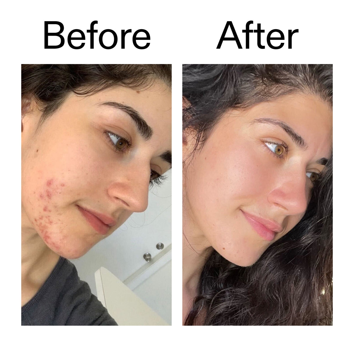 succinic-acid-acne-treatment-t4 Succinic_Acid_Treatment_Before_After_2000x2000_6a5f0054-2f58-4433-9314-0dc72c9bdd3b.jpg