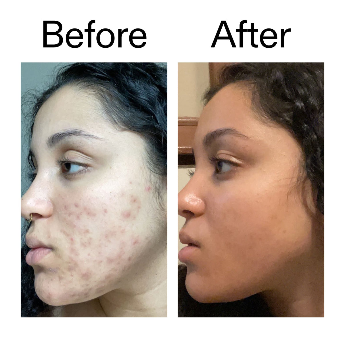 tranexamic-acid-serum-c6 Tranexamic_Acid_Serum_Before_After_2000x2000_98ebc8be-77b0-4843-8a22-90790ebe918b.jpg